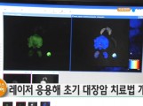 레이저 응용해 초기 대장암 치…